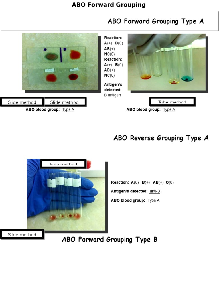 ABO Forward Grouping Type A: Slide method Tube method Slide method ...