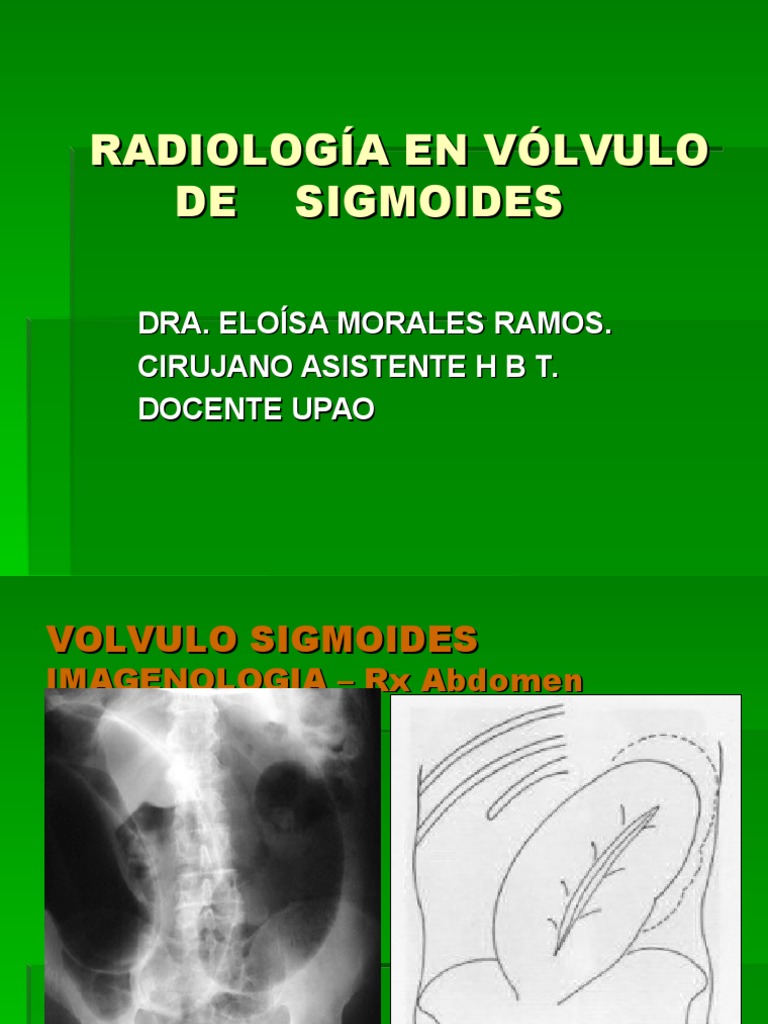 RX. Vólvulo de Sigmoides | PDF