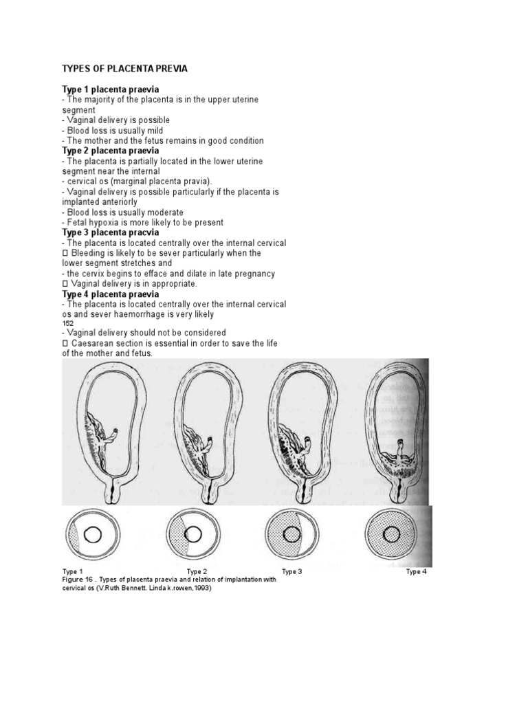 Types Of Placenta Previa Pdf