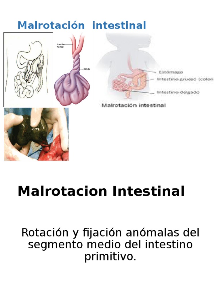 malrotaci-n-intestinal-en-neonatos-pdf-abdomen-especialidades-medicas