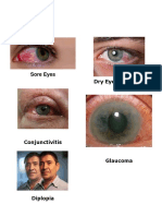 Sore Eyes: Dry Eye Syndrome
