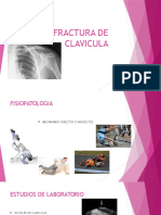 Fractura de Clavicula