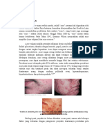 Acne Vulgaris