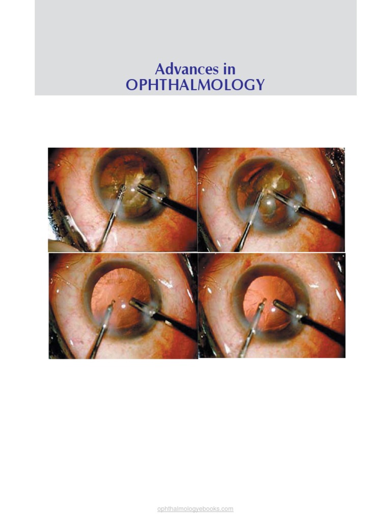 Advances in Ophthalmology PDF Anesthesia Ophthalmology pic