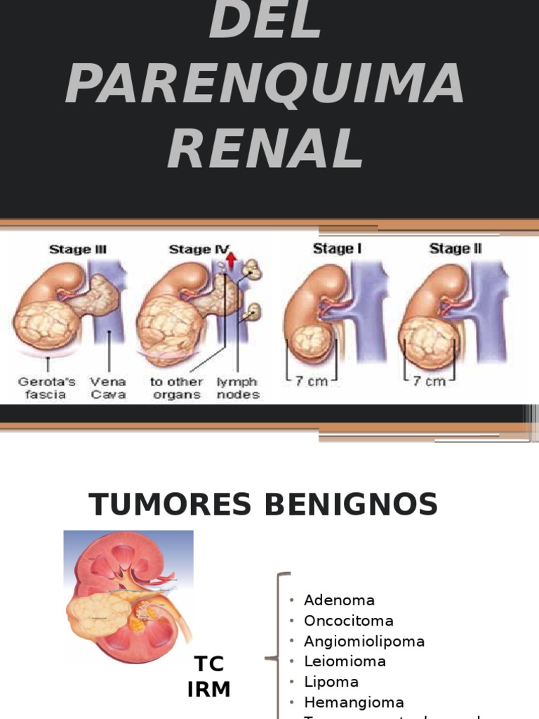 neoplasias del parenquima renal | Metástasis | Cáncer