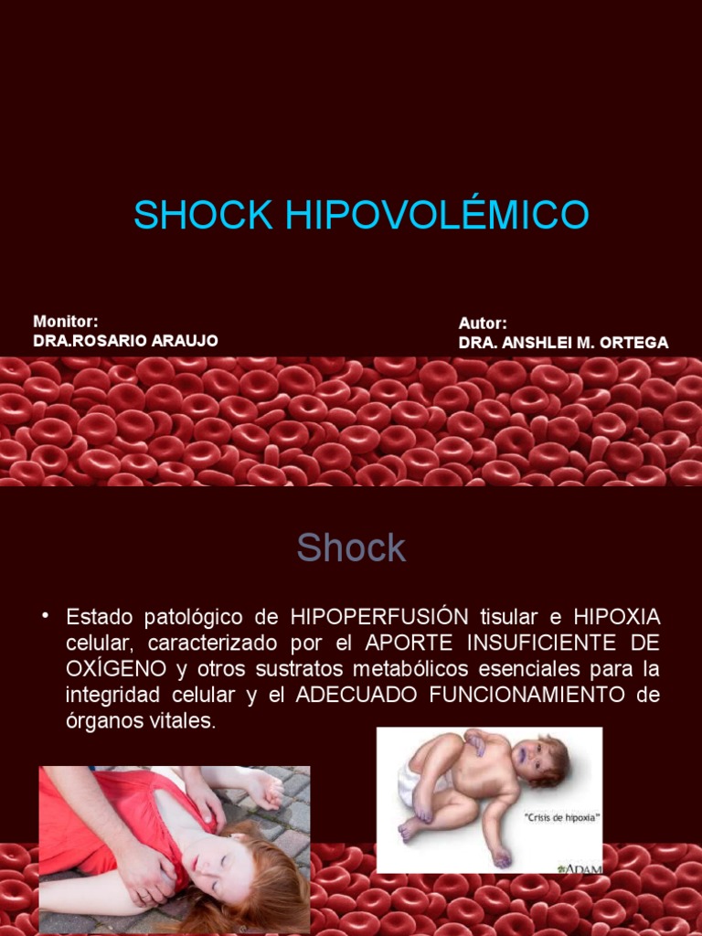 Guía Completa sobre Shock Hipovolémico | PDF | Choque (circulatorio ...