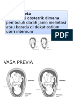 TL Vasa Previa