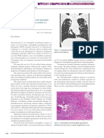 Eosinophilic Granulomatosis With Polyangiitis Associated With Subcutaneous Nodules in A 10-Year-Old Gir