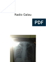Radio Galau