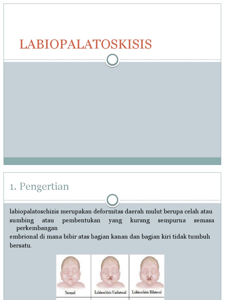 Labiopalatoskisis: Penyebab dan Penanganan | PDF
