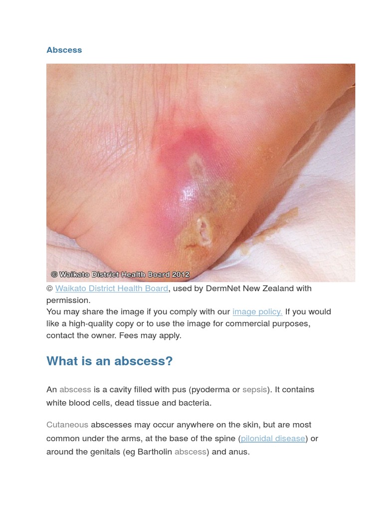 Abscess Infection Medical
