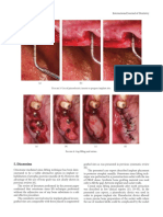 Discussion: Figure 5: Use of Piezoelectric Inserts To Prepare Implant Site