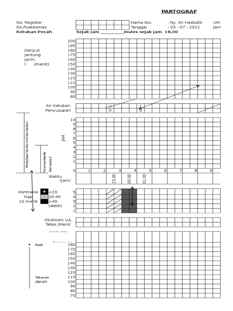 Contoh Pengisian Partograf Persalinan | PDF