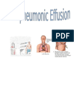 226458652 Parapneumonic Effusion Case Study Adult I