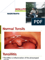 CHRONIC TONSILLITIS SYMPTOMS AND TREATMENT