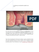 Scapa de Hemoroizi Cu Acest Leac Pe Care Il Poti Face Rapid in Casa