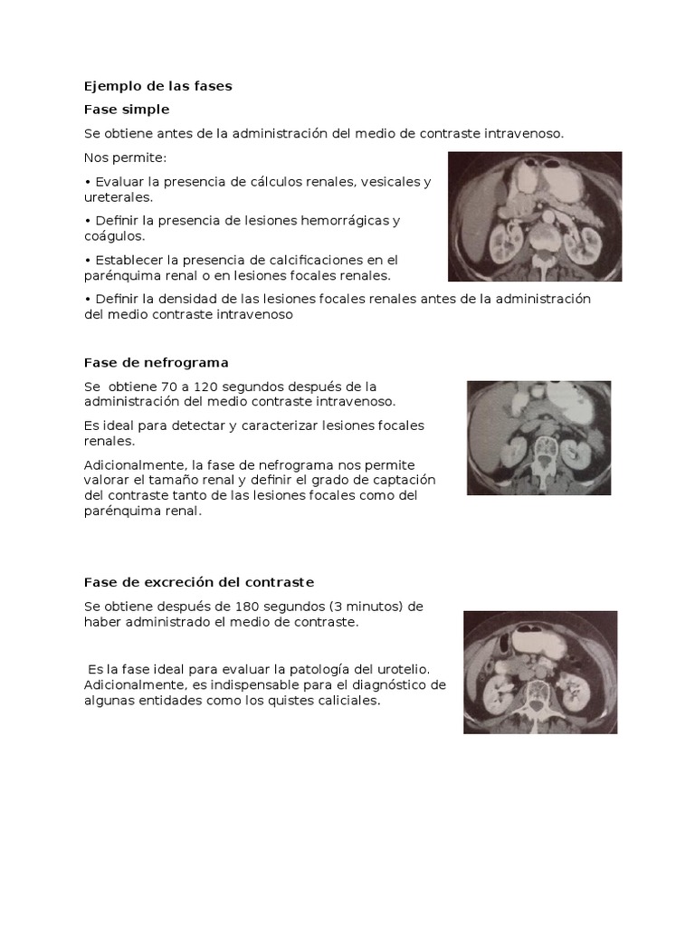 Ejemplo de Las Fases TAC Renal | PDF