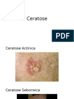 Ceratose e Esclerose