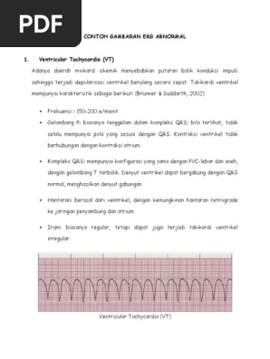 Unduh 91 Gambar Gelombang Jantung Normal  