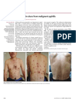 Multiple skin ulcers from malignant syphilis.pdf