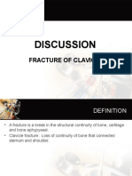 Clavicle Fracture