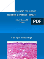 Telangiectasia Macularis Eruptiva Perstans (TMEP) - F 28, Right Thigh.