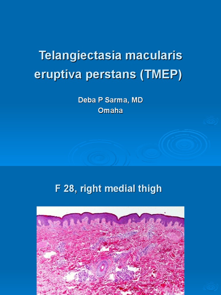 Telangiectasia Macularis Eruptiva Perstans (TMEP) F 28, Right Thigh