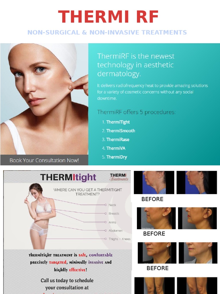 Non-Surgical Thermi RF Treatments | PDF | Home & Garden | Technology ...