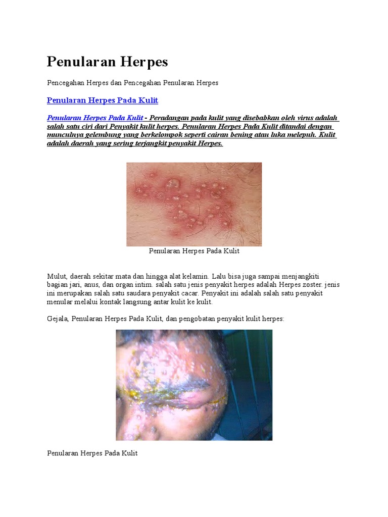 Penularan Herpes