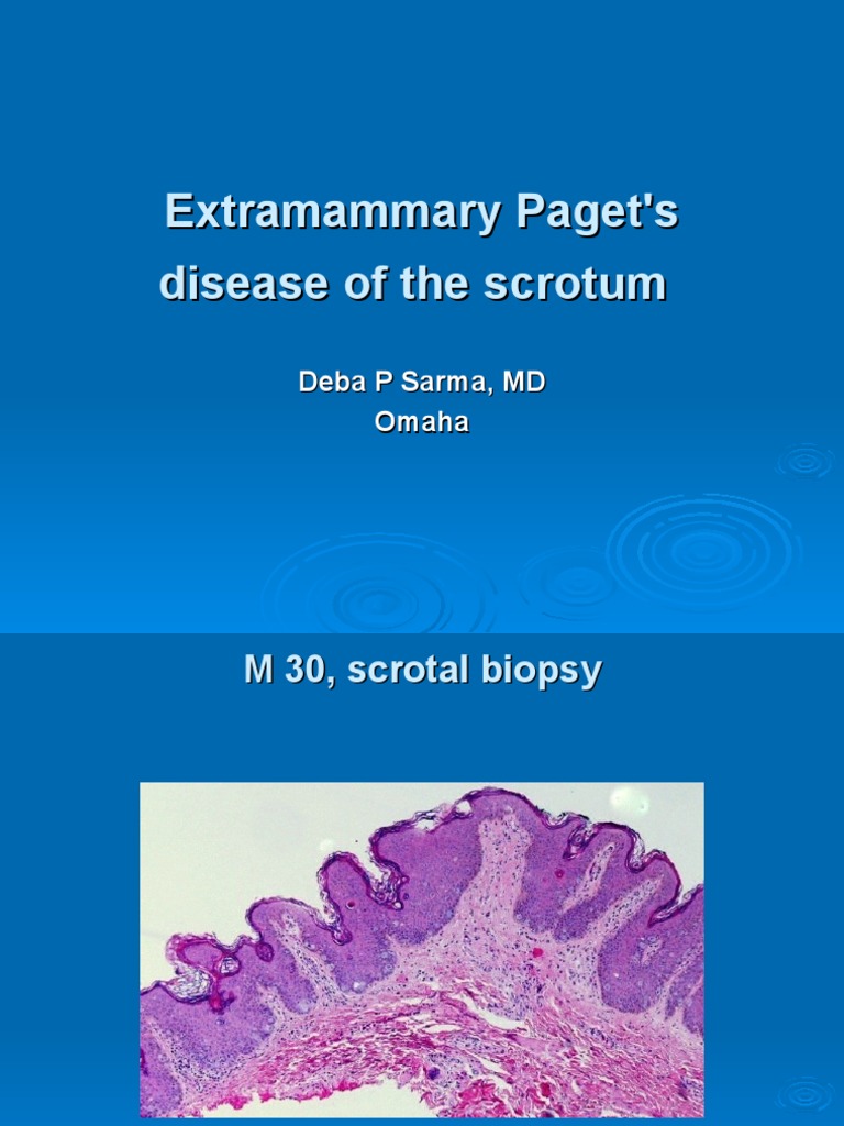 Extramammary Paget's Disease of The Scrotum, M 30, Scrotum PDF