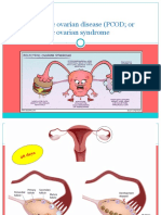 Polycystic Ovarian Disease (PCOD - 2