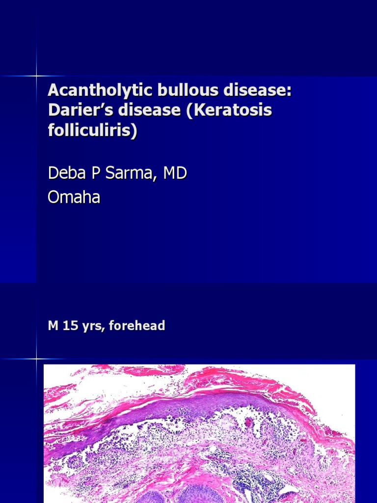 dr-sarma-s-dermpath-acantholytic-bullous-disease-darier-s-disease