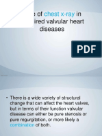 Role of Chest X Ray in Acquired Valvular Heart Disease