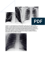 Radiologi penyakit jamur paru