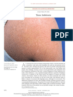 Tinea Imbricata: Images in Clinical Medicine