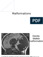 DW malformations