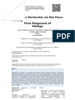 Pityriasis Versicolor On The Face-Wrong First Diagnosis of Vitiligo