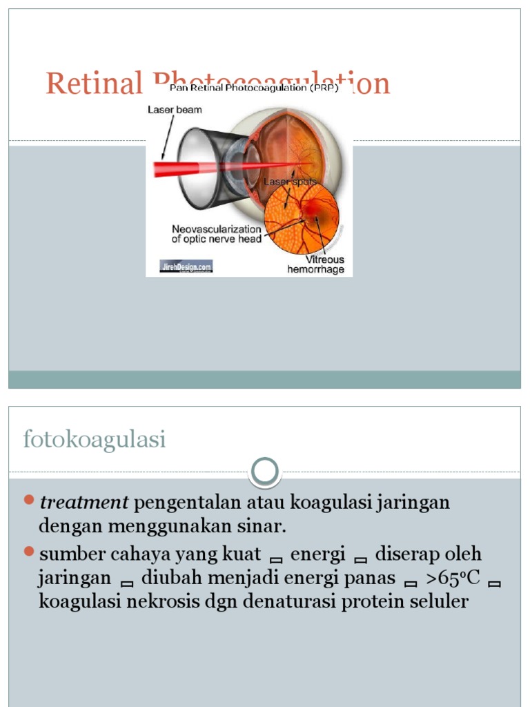 Retinal Photocoagulation | PDF | Sains & Matematika