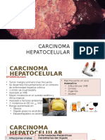 carcinoma hepatoca.pptx