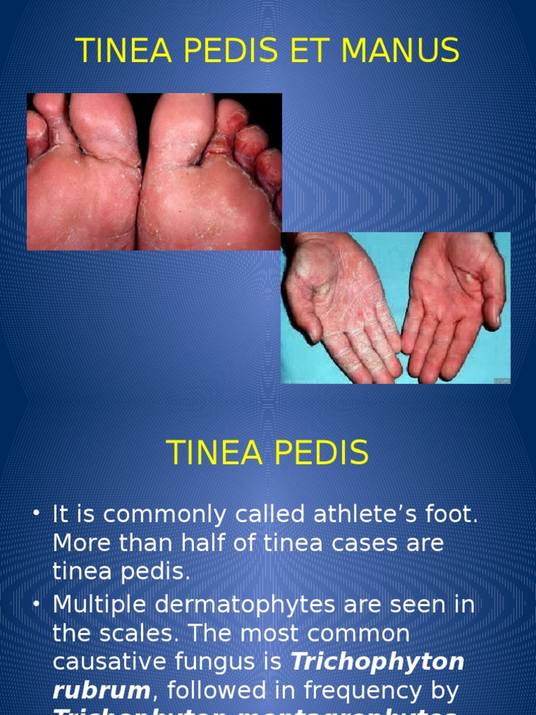 Tinea Pedis Et Manus PDF Animal Diseases Microbiology