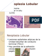 Neoplasia Lobular: Características, Diagnóstico y Manejo