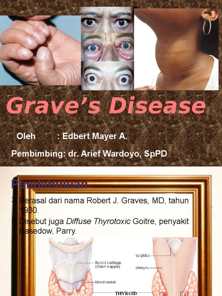 Grave's Disease PDF
