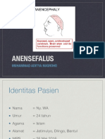 Anencephaly