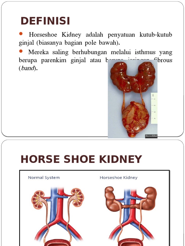 Horse Shoe Kidney