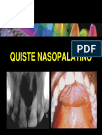 QUISTE NASOPALATINO.pdf
