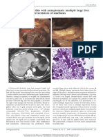 Severe Right-Sided Colitis With Asymptomatic Multiple Large Liver Abscesses: Unusual Presentation of Amebiasis