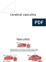 Cerebral Vasculitis