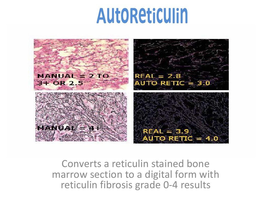 Reticulin Fibrosis Grading in Bone Marrow | PDF | Computers