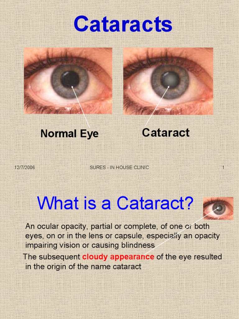 Cataract Information | PDF | Cataract | Human Eye