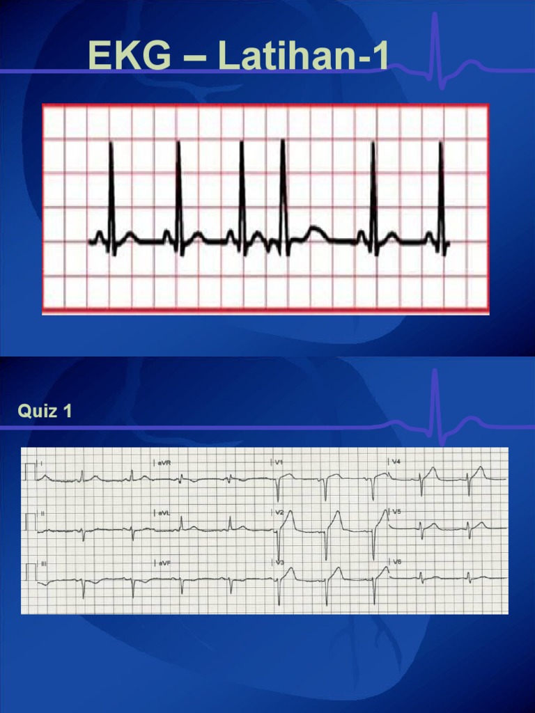 EKG Quiz: Myocardial Infarction Types | PDF | Wellness | Science ...